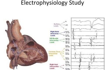 Estudio Electrofisiológico del corazón en Torrevieja